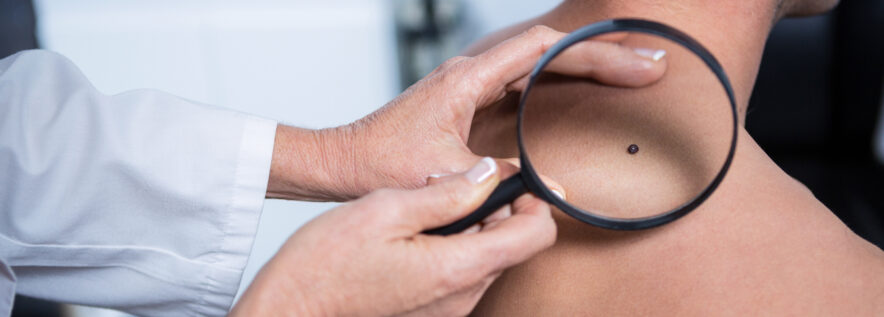 Bezpłatne badania znamion skór